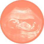 Preterm Birth image
